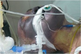 Phú Thọ: Một bệnh nhân tử vong do ăn tiết canh lợn