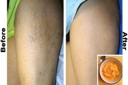 Suy giãn tĩnh mạch biến mất nhờ đắp hỗn hợp nha đam