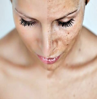 Vĩnh biệt tàn nhang với vài mẹo nhỏ