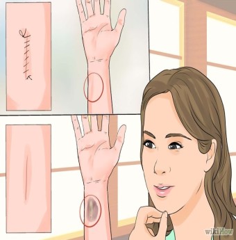 4 thực phẩm giúp vết thương trên da mau lành