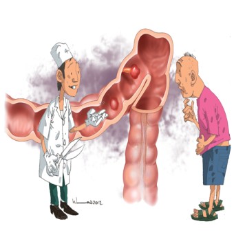 Ung thư đại tràng: Đừng nghĩ 1% là thấp