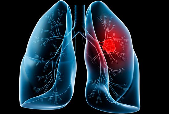 Cảnh báo: 4 nhóm nghề có nguy cơ mắc ung thư phổi cao nhất1