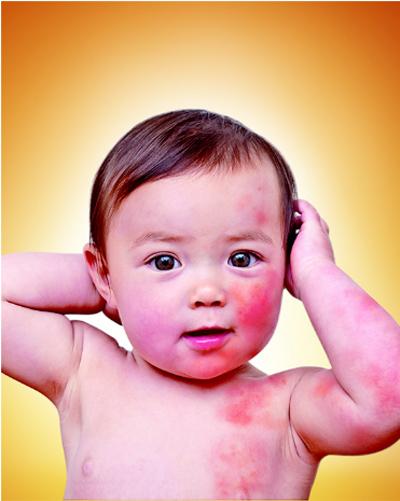 Những điều mẹ cần biết khi con dị ứng đạm sữa bò 1 Những điều mẹ cần biết khi con dị ứng đạm sữa bò 1